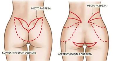 Пластика ягодиц в Киеве | Цена подтяжки ягодиц от 35000 грн | Акции