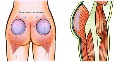 Пластика и увеличение ягодиц [2024] Низкая цена