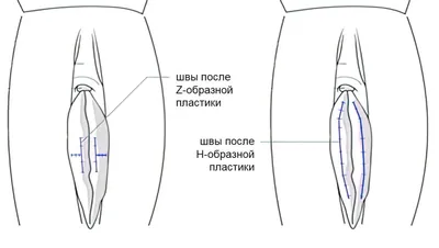 Интимная пластика: до и после, отзывы о контурной пластике филлерами |  Косметология и эстетическая медицина | Дзен