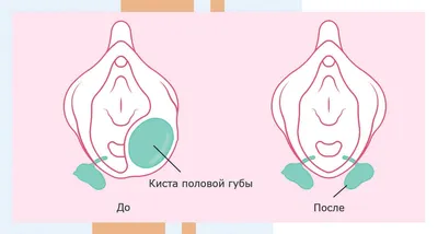 Лабиопластика в Киеве ♻️ Пластика и коррекция половых губ, цены | Мед Сити