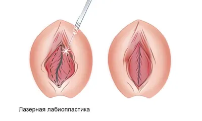 Как выглядят нормальные половые губы