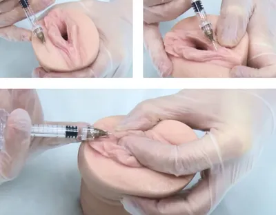 Растянутые половые губы | Хирургическая коррекция дефекта в клинике  профессора Блохина