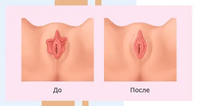 Пластика влагалища (вагинопластика) в Москве - цена пластики передней и  задней стенок влагалища