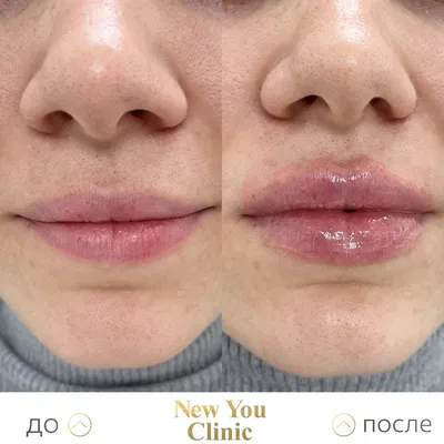Интимная пластика половых губ (лабиопластика) Цена в Москве в клинике  Медведева