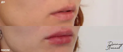 Лабиопластика интимная хирургия пластика до и после пластика интимной зоны  пластика половых губ