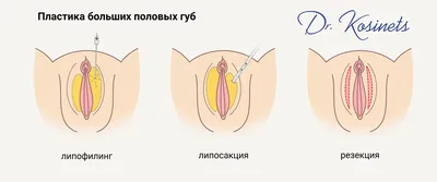 Лабиопластика - Цена операции, сделать пластику половых губ в Минске
