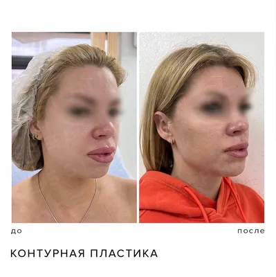 Коррекция овала лица | Цены в Москве | Age Clinic