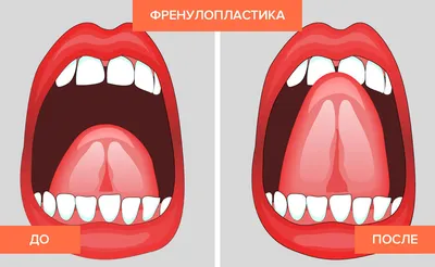 Пластика уздечки языка - Сеть стоматологических клиник Санкт-Петербурга -  Мир стоматологии