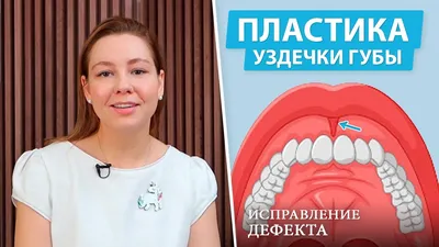 Френулопластика в Краснодаре: избавление от Пластика уздечки губы, языка -  Стоматология доктора Айрумова «32 Clinic»