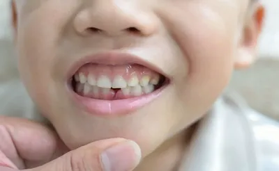 Пластика уздечки верхней губы (френулопластика) - YouTube