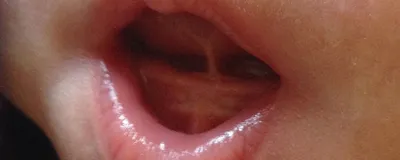 Пластика уздечек языка, верхней и нижней губы у детей | Стоматологическая  клиника «Мартинка»