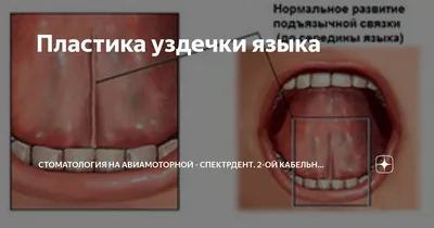 Пластика уздечки языка: Андрюша, 4 годика | Детская и семейная  стоматологическая клиника \"Белая Медведица\" | Санкт-Петербург