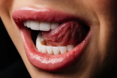 Имплантация зубов: примеры работ по установке имплантов до и после в  стоматологии OneDent