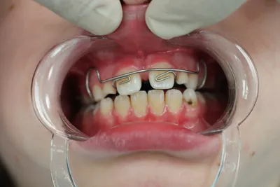 Пластика уздечки верхней губы (Френэктомия) скальпелем - «Подрезание уздечки  верхней губы» | отзывы