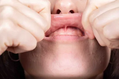 Пластика уздечки губ и языка в Казани — стоимость подрезания в стоматологии  Миллидент