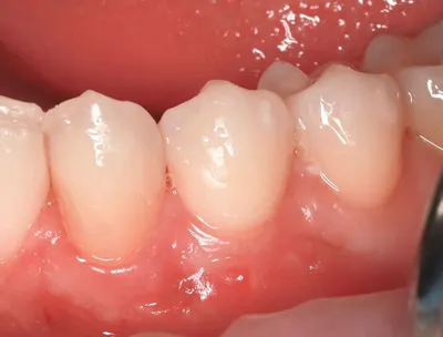 Пластика уздечки верхней губы: подрезание короткой уздечки в SILK