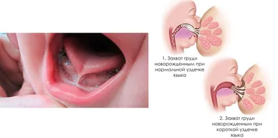 Пластика уздечки языка в Лобне — цены от 3 000 ₽ в 1 клинике на портале  TopDent.ru