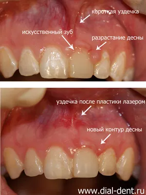 Логопед после подрезания уздечки у ребенка. Блог Лого-Эксперт