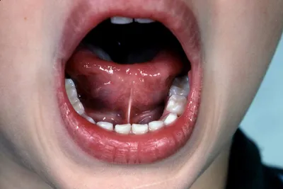 Пластика короткой уздечки языка, верхней и нижней губ у ребенка