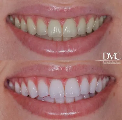 Тканная пластика десны фото до после лечения пациента | стоматология Эксперт