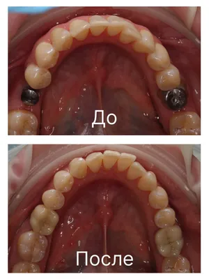 СЕМЕЙНАЯ СТОМАТОЛОГИЯ АЛМАТЫ on Instagram: \"Пластика уздечки языка до/после\"