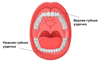 Пластика уздечки губы и языка - все нюансы операции - ЭяпаДент