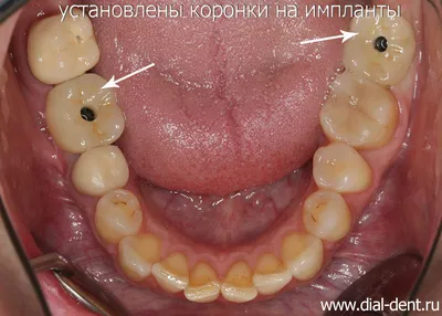 Косметические пластинки для замещение от 1-го до 3-х зубов в Томске