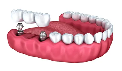 Имплантация трех зубов в Москве под ключ недорого, цены от ДантистоФФ