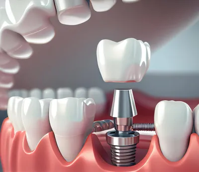 Протезирование переднего зуба на импланте
