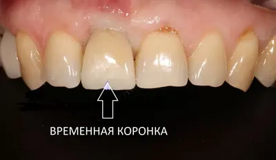 Временные коронки как важный этап имплантации - Немецкий имплантологический  центр