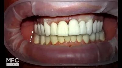 Протезирование зубов. Фиксация временных коронок. Часть 1. - YouTube