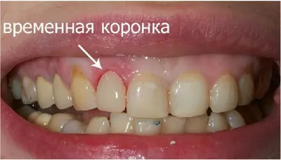 Зубной временный протез при имплантации зубов, сколько стоит временный  протез передних зубов бабочка