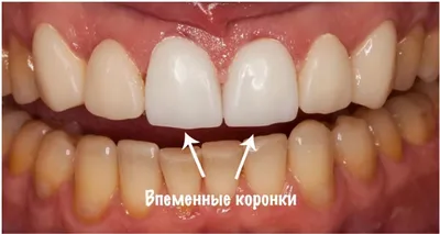 Зубной временный протез при имплантации зубов, сколько стоит временный  протез передних зубов бабочка