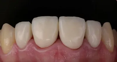 Временные коронки на зубы: цена на временные коронки на имплант на передний  зуб