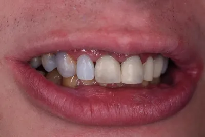 Временные коронки на передние зубы: стоимость, установка, описание процедуры