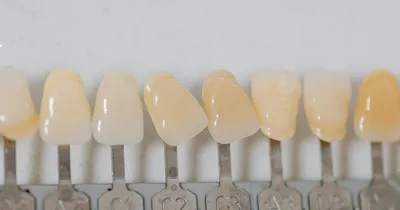 Можно ли поставить на фронтальные зубы коронки, а дальше протез? - форум  Стоматология.Су