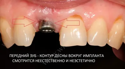 Коронки на передние зубы [стоимость, какие лучше?]