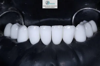 Этапы установки пластмассовых коронок – стоматология ПрезиДЕНТ