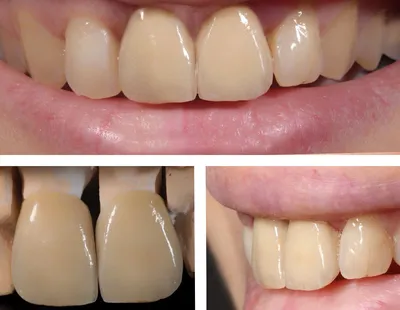Коронки на коренные зубы | Виды, преимущества, недостатки | Клиника  семейной стоматологии Дока-Дент
