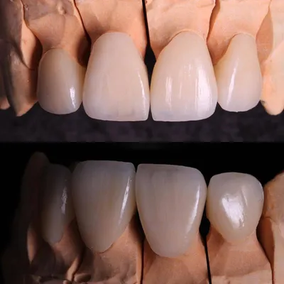 Временные короны, плакаты, передние/задние зубы моляра, зубы, крышки  стоматологических искусственных зубов, виниры | AliExpress