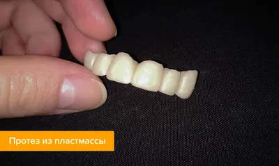 Пластмассовые коронки на зубы – цена, отзывы, фото, этапы установки —  Startsmile