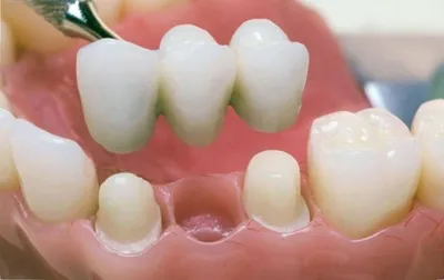 Зубные коронки из металлопластмассы — Добрый доктор