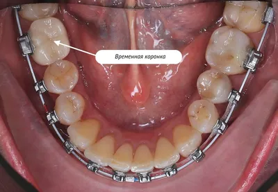 Как ставят коронку на зуб: подробные этапы процедуры установки зубной  коронки в стоматологии