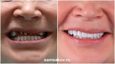 Установка коронки на зуб: циркониевые и керамические | Альянс  бьюти-ортопедов, Москва