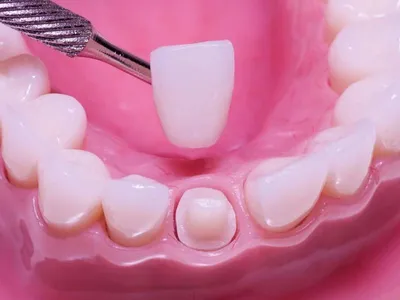 Циркониевые коронки на передние зубы Кейс №5 - примеры работ стоматологии  KANO
