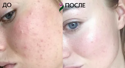 Плазмолифтинг лица до и после, плазмолифтинг эффект