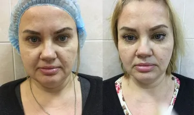Плазмагель Эндорет в Краснодаре — цены, записаться онлайн в «EVA Clinic»