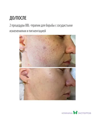 Что такое плазмолифтинг лица: все о процедуре