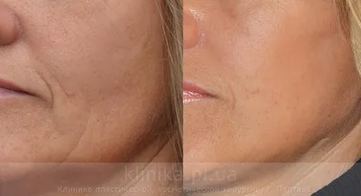 Плазмолифтинг для лица: проведение, показания и противопоказания | Telos  Beauty