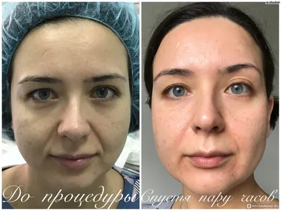 Что такое плазмолифтинг: проверяем на себе | Beauty Insider